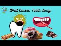 What causes tooth decay? What are cavities? Causes of tooth damage