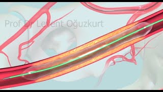 Anjiyo yöntemiyle balon ve stent kullanarak tıkalı damarı açmak Resimi