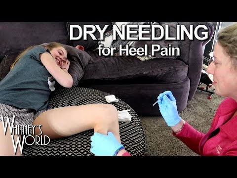 Dry Needling for Heel Pain | Whitney Bjerken Gymnastics