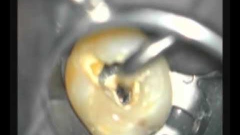 Elements Obturation Unit