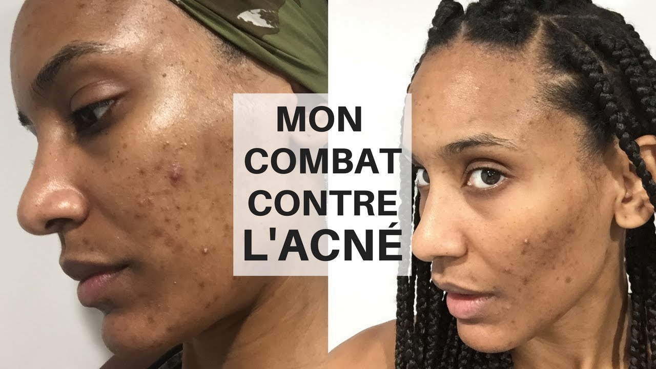 Mon combat contre l'acné - Olivia rose