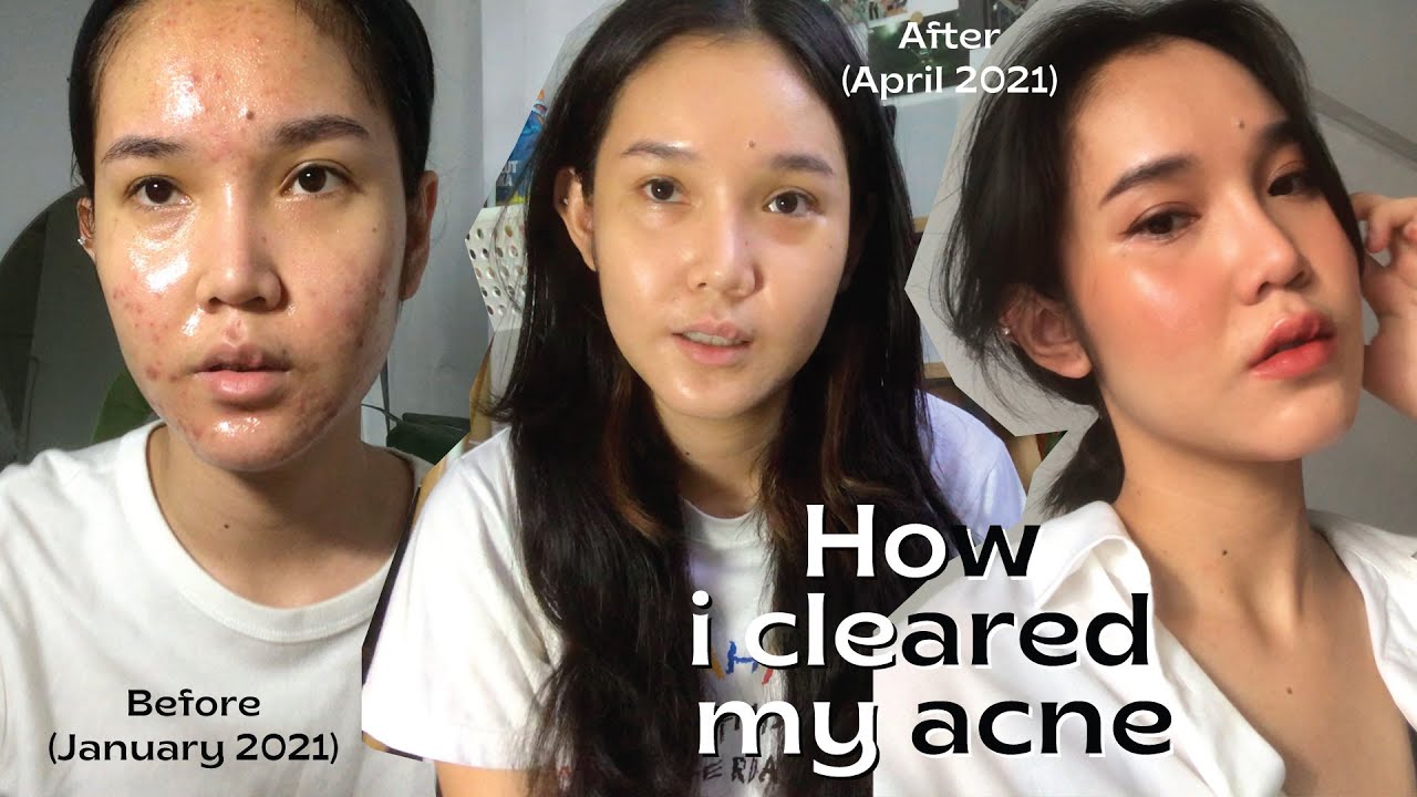 พร เกษม เดอะมอลล์ บางกะปิ New How I cleared my acne 💊| สกินแคร์รักษาสิว, รีวิวเลเซอร์สิวแบบพรีชีพ, รักษาสิวให้หายใน 4 เดือน