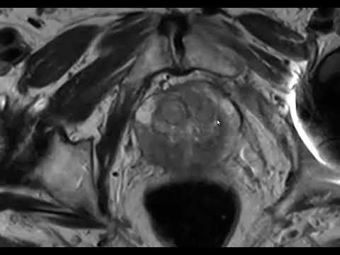 Video: Trend Dalam Brachytherapy Prostat Yang Disasarkan: Dari MRI Multiparametrik Kepada Radiosensitizers Nanomolecular