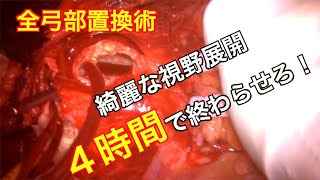 全弓部置換は４時間で終わらせろ！　Total Arch Replacement 弓部大動脈瘤【俺に切らせろ！】