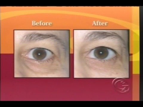 Dr. Jason Leedy discusses Botox, Restylane, and Sm...