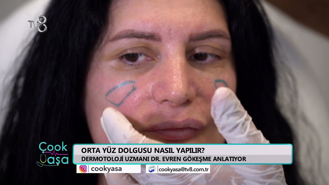 Orta yüz dolgusu nedir? nasıl yapılır?