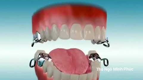 Khí cụ sửa chữa lùi hàm dưới ra sau - Class 2