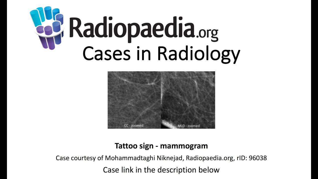 Tattoo sign Cases in Radiology YouTube