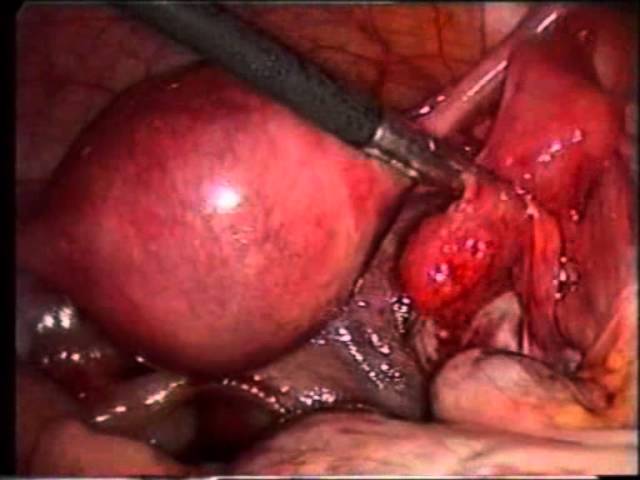 Трубная беременность. Операция с сохранением маточной трубы. Техника милкинг (milking)
