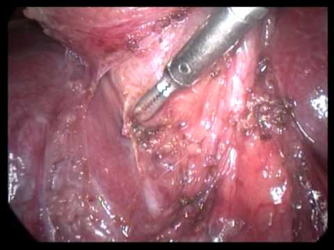 Lap  Cholecystectomy Unedited 367  Chronic GB  Omental Adhesion With Difficult Neck Dissection