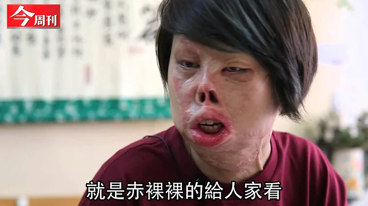 《今周刊》火烧截3肢  钢铁女孩：我赤裸裸的给人家看 - 天天要闻