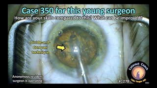 CataractCoach 1278: case 350 for a young surgeon