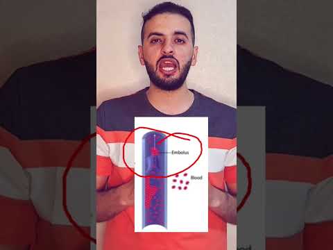 الفرق بين  و    جلطة