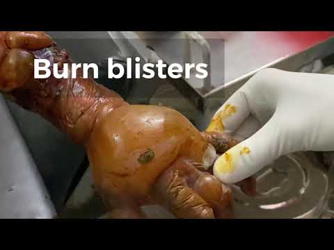 Video: Bør Du Poppe En Burn Blister?