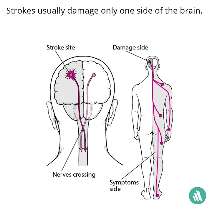 Why do strokes usually affect only one side of the body youtube