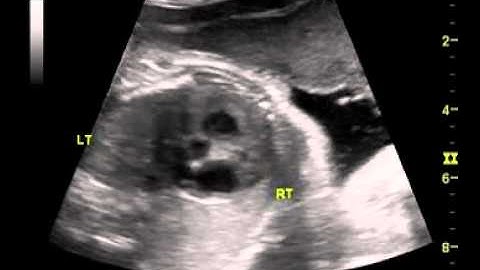 mild hypoplasia Left heart-final joined-1a