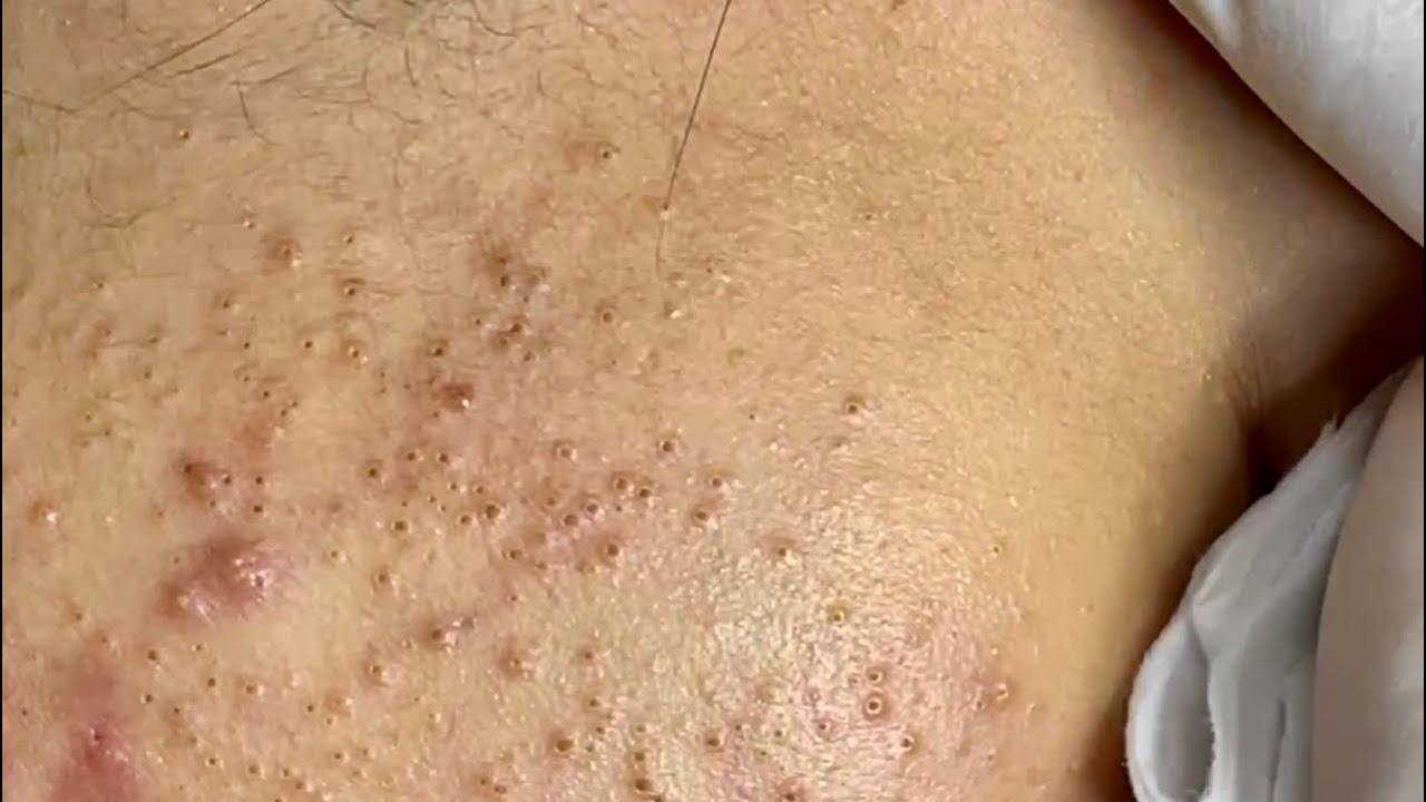 Huyen phan treantment acne #091 #acne #mun #trimun #nanmun #huyenphan