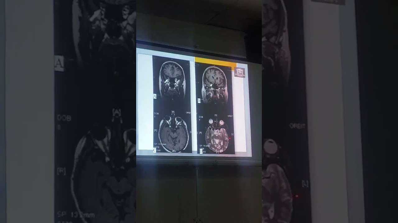Ct-MRi ophthalmology view .Dr.Ahmed sallam