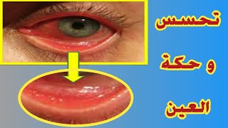 علاج حساسية و حكة العين و ما هي أعراضها و أسبابها ؟
