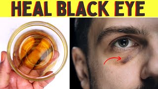 How to heal a black eye faster overnight   Fix bruised eye