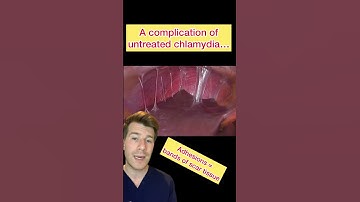 Adhesions … a complication of untreated chlamydia #shorts #medical #doctor #chlamydia #foryou