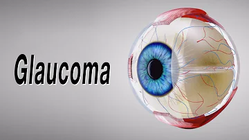 ¿Qué se considera glaucoma limítrofe?