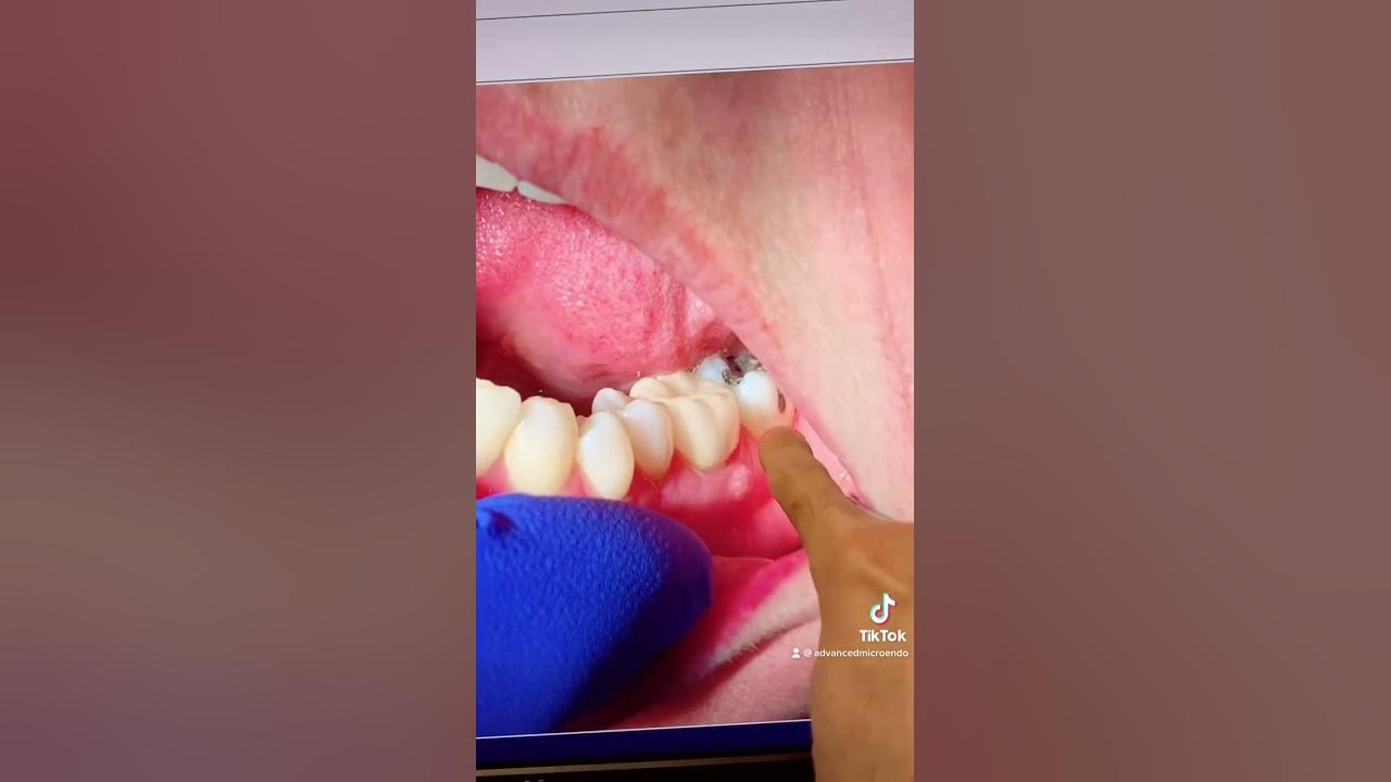 Endodontic retreatment of tooth 19 through a porcelain crown in one
