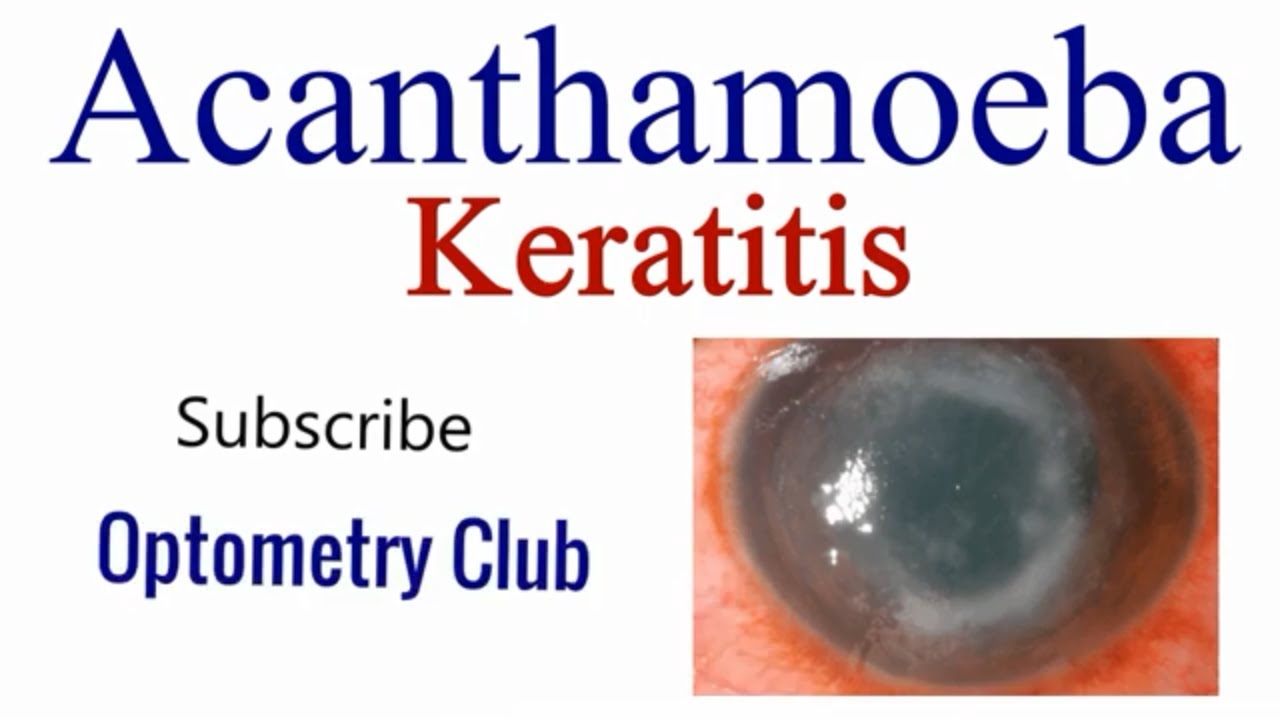 acanthamoeba-keratitis-introduction-clinical-features-investigation