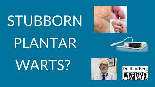 Tried Everything for Plantar Warts? What We've Learning Using Swift Therapy!