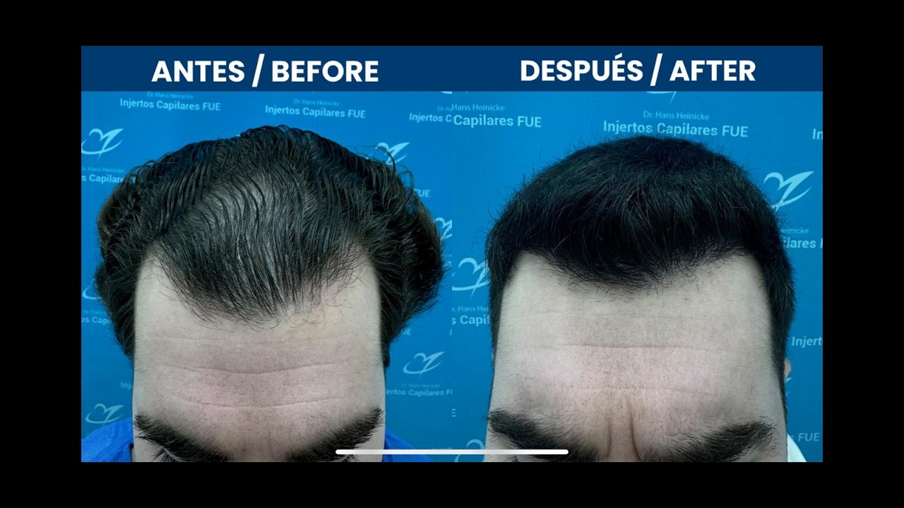 Injerto Capilar Lima 2831 folículos (8346 pelos)