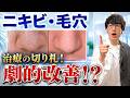 ニキビ・毛穴に効くイソトレチノインは体に悪い？よくある副作用と本当に注意すべき危険を薬剤師が解説