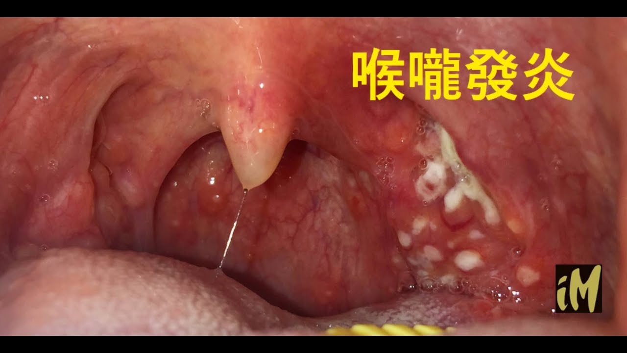 鏈球菌咽喉炎發燒 鏈球菌感染症狀 Delhcat