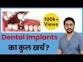 What is the cost of dental implants 