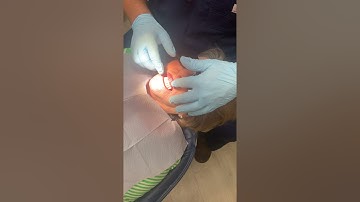 Complete Denture Troubleshooting #1