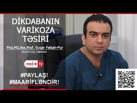Dikdabanin varikoza tesiri haqqinda (VARIKOZ) - Phd,MD,Ass.Prof. Vuqar Fattah-Pur Fleboloq Cərrah