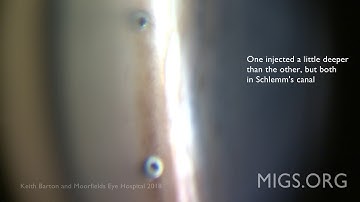 2 x iStent Injects in TM 2 weeks after Phaco iStent Implantation