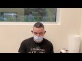 Dallas FUE Hair Transplant Testimonial One Day Out