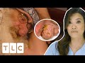 Patient Struggles To Breathe At Night With Hugely Overgrown Nose I Dr Pimple Popper