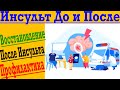 Профилактика Инсультов и Восстановление после Инсульта !