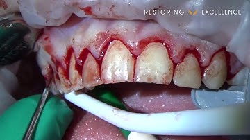 Crown Lengthening with Dr Lincoln Harris