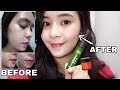 ACNE SKINCARE ROUTINE + Before &amp; After ft. COMMONLABS.