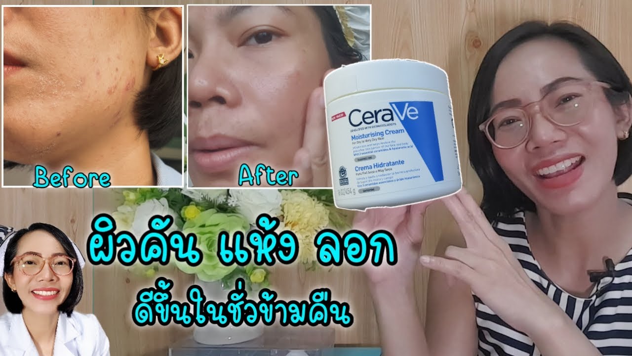 ผิวแห้งมาก  2022  ผิวแพ้แห้งคันระคายเคือง ลอก หยาบกร้าน จบด้วยCeraveมีCeramide