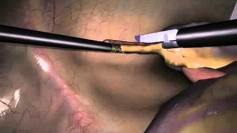 LapSim Appendectomy: Optional Stapling