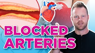 How To Prevent and Reverse Clogged Arteries | Heart Attacks