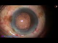 The concept of contact lens to protect pc in hard cataract with weak zonule  p mohanta 3 feb 2024