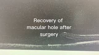 Recovery of macular hole after surgery