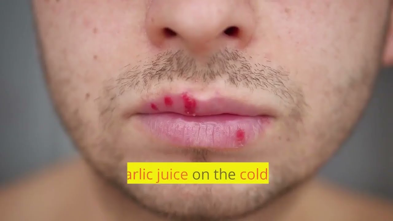 “Natural Remedy: How to Treat Cold Sores with Garlic – DIY Home Remedies”