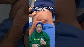 Video Versi Luar Ya, Usaha Memutar Janin Dari Luar Perut Ibu