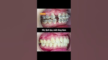 Cận cảnh quá trình điều trị hô, lệch lạc và mất răng hàm