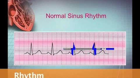 Intro EKG Interpretation Part 2 (Maab)